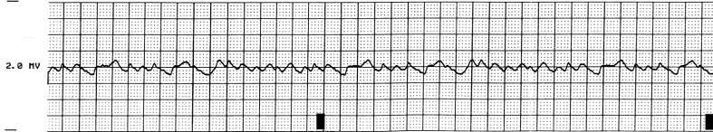If That Didn t Make You Nervous Primary VF: Sudden event with no warning--10% STEMI patients before lytics.