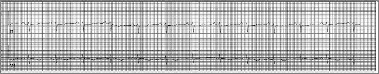 early myocardial infarction Brother at 35 years old