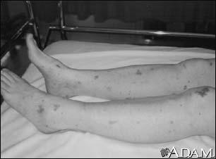 Rash #3 A 27 year old woman is brought to the ER in shock with an unusual rash that developed after one day of fever and myalgias without headache.