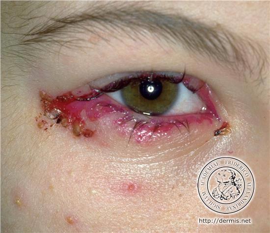 superficial lesions involving the external eye, to severe sightthreatening diseases of the inner eye.