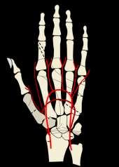 palsy Ape hand median