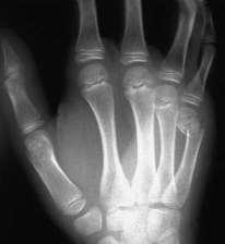 METACARPAL NECK FRACTURE The most common hand fractures Boxer s fracture: fracture of the neck of 5 th m-c All have volar angulation Ring & 5 th mc tolerate greater angulation Ring < 35, 5 th < 45