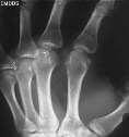 METACARPAL SHAFT FRACTURE Angulation rarely acceptable for 2 nd and 3 rd Angulation amounts that are acceptable: Index 10 Long 20 Ring 30 Small 40 Operative fixation is often required for 2 nd and 3