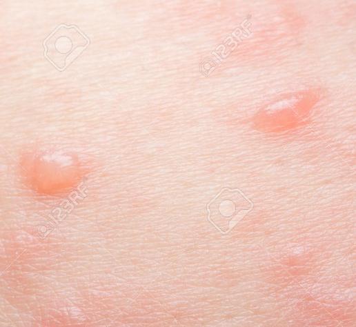 lesions lesions are sites of viral