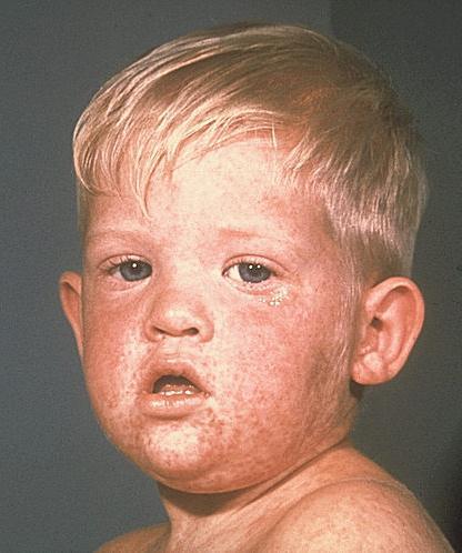 Measles Rash Maculopapular