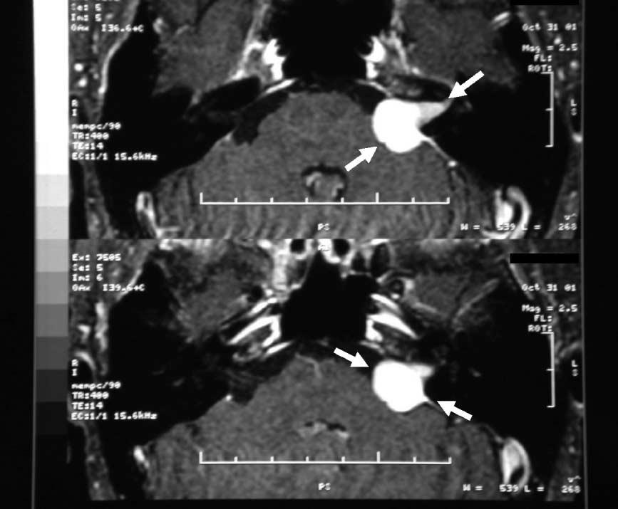COMPARISON OF GROWTH PATTERNS OF ACOUSTIC NEUROMAS 707 FIG. 1. MR image showing the direction of the ML (top arrows) and the AP (top arrows) measurements in a Jackler Stage II acoustic neuroma.