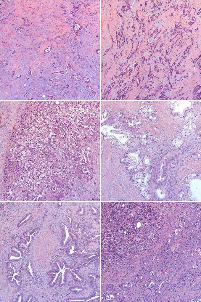 Gonzalez et al. Page 17 Figure 4. Morphologic variants of otherwise pancreatobiliary-type distal common bile duct carcinoma. (a) Tubulolobular features, reminiscent of mammary carcinoma.