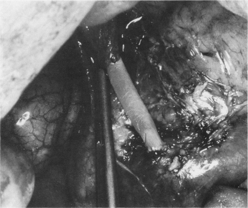 Total and subtotal replacement of the common bile duct Fig. 1 GROUP II Total replacement of bile ductfrom level just distal to cystic duct to duodenum. Gall bladder is left in situ.