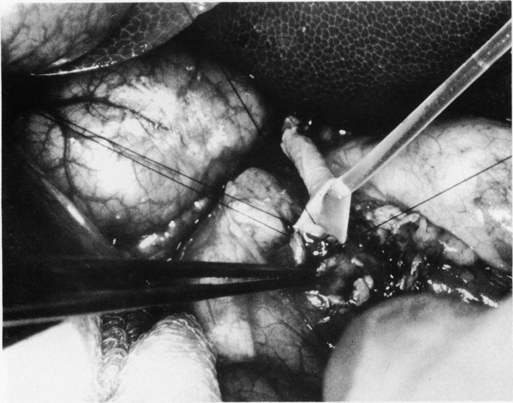 758 Cushieri, Baker, Anderson, and Holley Fig. 2 Total replacement of bile duct with transhepatic silicone tube stenting. Stent had multiple side holes corresponding to its intrahepatic course.