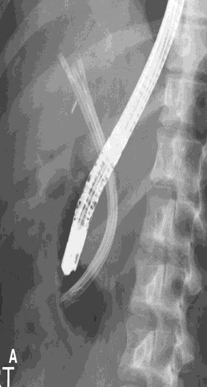 ERCP multiple stents Lateral duct wall injury or cystic duct leak transampullary stent controls leak &