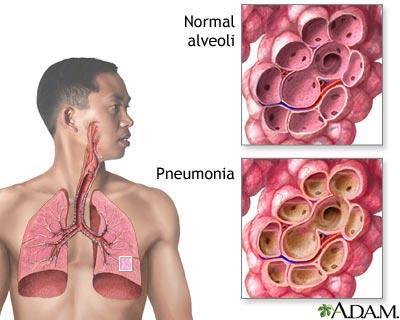Pneumonia Inflammatory illness of the lung Lung inflammation and abnormal fluid filling the alveolar Caused by bacteria, viruses, fungi,