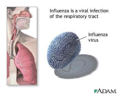 Influenza Contagious respiratory illness caused by flu viruses Usually comes on suddenly and may include fever,