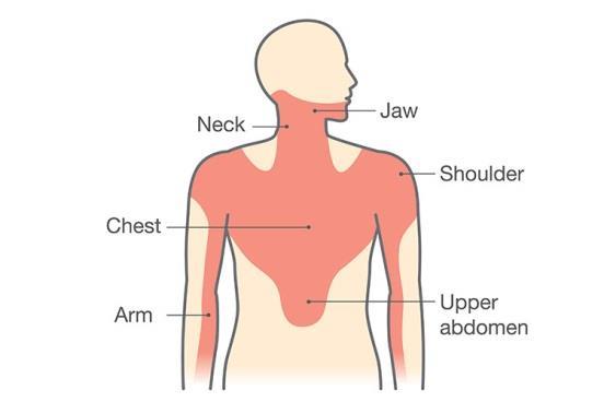 Assess typicality Chest Pain Stable Anginal pain is: 1. constricting discomfort in the front of the chest, or in the neck, shoulders, jaw, or arms 2. precipitated by physical exertion 3.