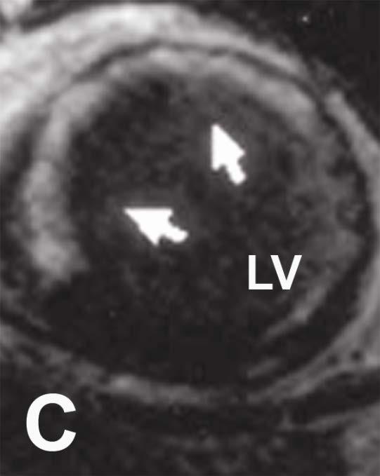 Dystrophinopathy extensive ring of subepimyocardial or midwall