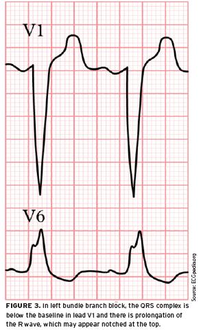 Left bundle branch block Partial or complete interruption in the conduction of electricity through the left bundle branch has a twofold effect: (1) a slowing in overall ventricular depolarization,