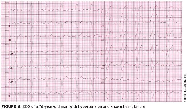 A 76-year-old man with hypertension and known heart failure presented with dyspnea. On physical examination, no heart murmur was appreciated but rales were heard in both lung fields.
