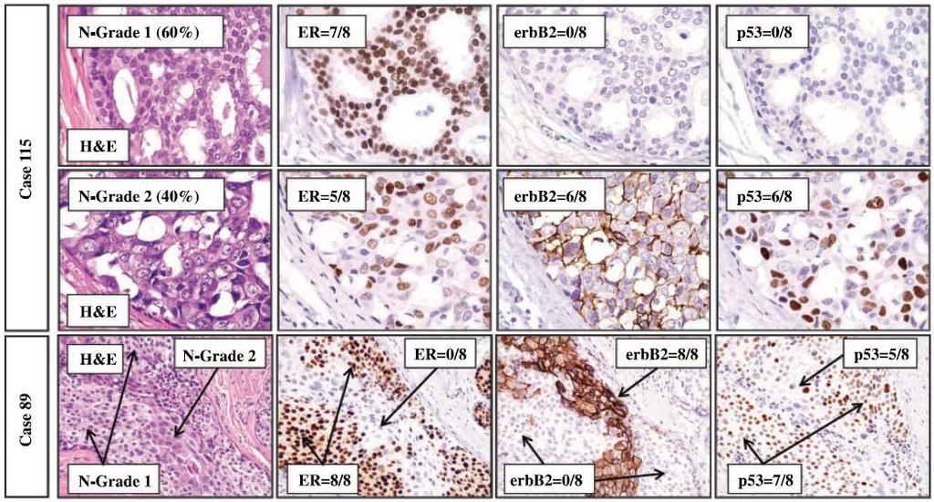 Molecular diversity in DCIS and IDC Histologic and biological diversity within cases of DCIS (nuclear grades) H&E-stained slides from 120 recent consecutive cases of pure DCIS no diversity (54.