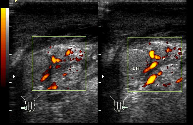 They are heterogeneous and of mixed echogenicity. The testes are normal. The Power Doppler image (Fig. 2 c) shows marked hyperaemia of the epididymides in keeping with acute epididymitis.