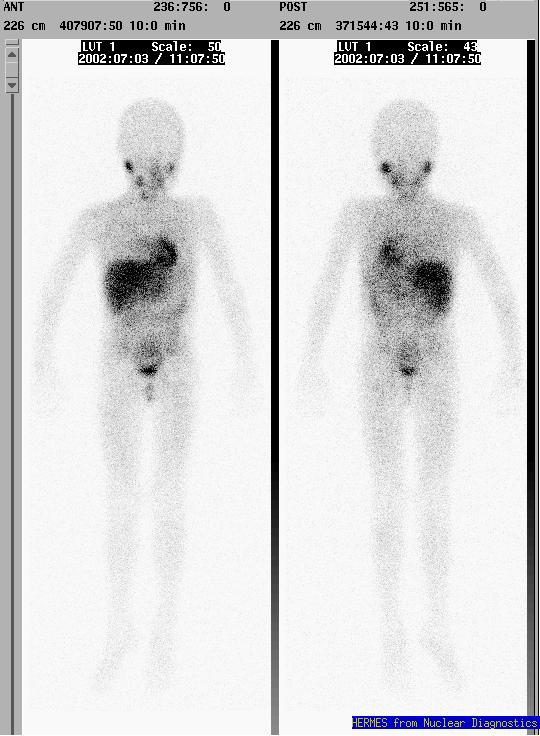 23 I-mIBG scan 7 mo after 3 I-mIBG therapy Normal mibg scan asde from a slghtly asymmetrc uptake n the thyrod bed (arrow) Example of tumour dosmetry Dosmetry study for thyrod ablaton: