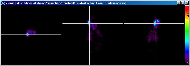 Absorbed dose maps Absorbed dose + CT Radaton Dose (Gy) 22 Transaxal Coronal Sagttal Maxmum voxel radaton dose Absorbed dose to blood.35 Maxmum voxel dose (Gy) 6. 5. 4. 3. 2....5.5 2.