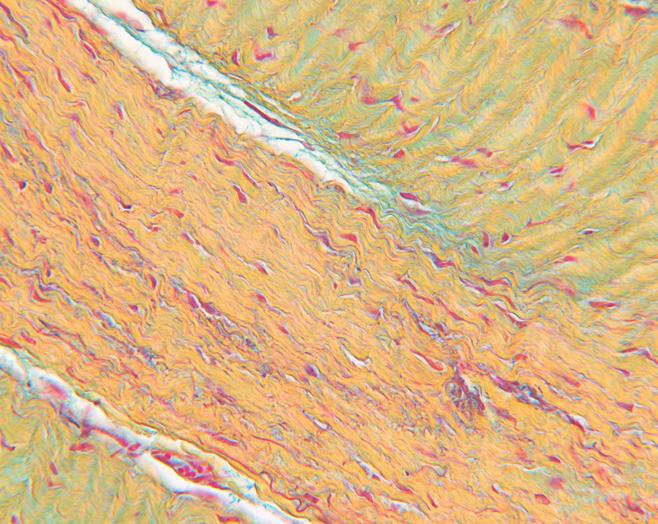 HISTOLOGICAL SCORES FOR FIBROBLAST REPOPULATION AND REVASCULARIZATION (ANIMAL MODEL) 3.0 3.0 Tutopatch Veritas Tutopatch Veritas 2.5 Neovascularization Score Fibroblast Repopulation 2.5 2.0 1.5 1.0 0.