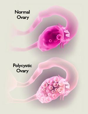 PCOS is the leading cause of anovulatory infertility and hirsutism 20-33% of all reproductive age group have polycystic ovaries 5-10% of all reproductive