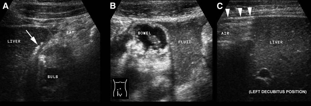 J.B.C.M. Puylaert / Radiol Clin N Am 41 (2003) 1227 1242 1241 Fig. 37. Perforated duodenal ulcer. (A) In the right upper quadrant impressive wall thickening in the duodenal bulb is found.
