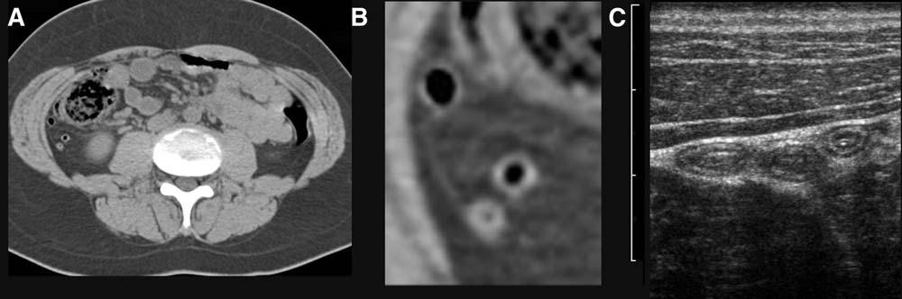 1228 J.B.C.M. Puylaert / Radiol Clin N Am 41 (2003) 1227 1242 Fig. 1. Visualization of a normal appendix by CT in an obese patient (A, B) and by US in a lean patient (C).