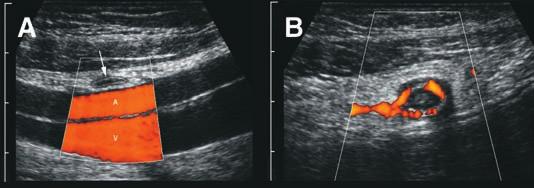 (A) The appendix has a maximal diameter of only 6.5mm; however, there is inflamed fat and an increased Doppler signal (B) indicating that it is acutely inflamed.