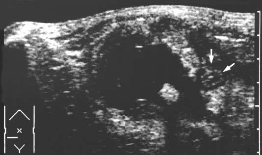 If next to the inflamed appendix a fluid collection is found, this is suggestive for an appendiceal abscess. The collection often contains air and is surrounded by Fig. 16.