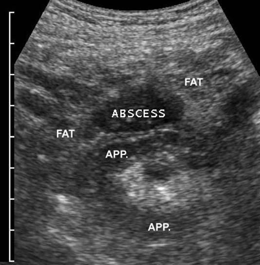 J.B.C.M. Puylaert / Radiol Clin N Am 41 (2003) 1227 1242 1233 Fig. 18. Acute appendicitis with a small periappendiceal abscess.