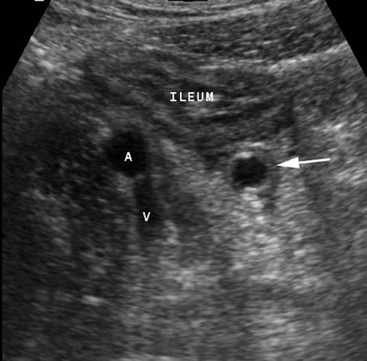 1234 J.B.C.M. Puylaert / Radiol Clin N Am 41 (2003) 1227 1242 Fig. 23. Crohn s ileitis with fistula (arrow) to the adjacent appendix.