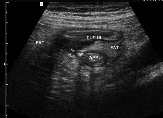 If in a patient with appendicitis only the fecalith in the appendiceal base is visualized and the rest of the appendix is overlooked, this may lead to an erroneous diagnosis of cecal diverticulitis.