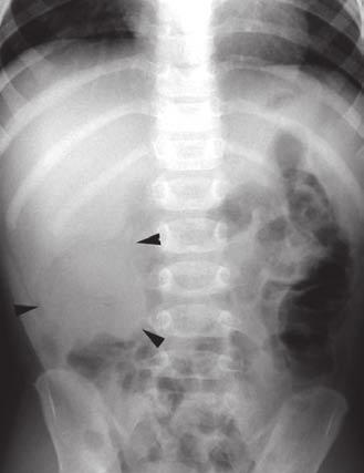 The intussusception was thought to be at the junction of the descending and sigmoid colons, subsequently confirmed with a barium enema.
