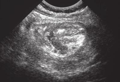 Figure 1b (right): Transverse ultrasound image from the left iliac fossa, showing an intussusception, with arrow heads indicating the outer margin of the invaginated bowel.