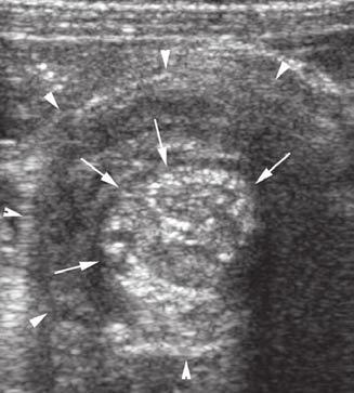 Plain radiography showed a rounded soft tissue mass to the right of the midline, possibly representing an intussusception.