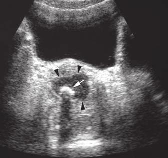 Figure 6a (below right): Supine abdominal radiograph showing a suspected calculus (arrow head) projected over the right edge of the lower sacrum.