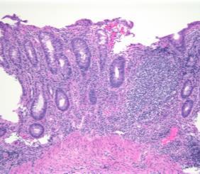 features Ulcerative colitis Contiguous disease with rectal involvement DDASC