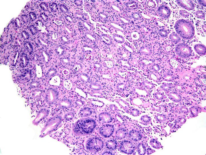 NSAID-Associated Colitis variable histology Patchy colitis with mixed inflammation, including neutrophils Intraepithelial lymphocytes Superficial