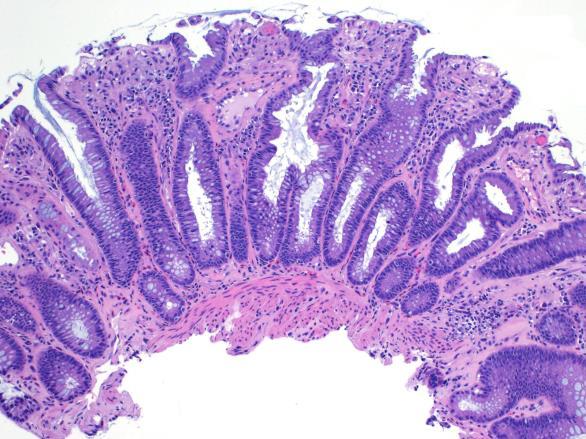 inflammatory bowel disease Yersinia