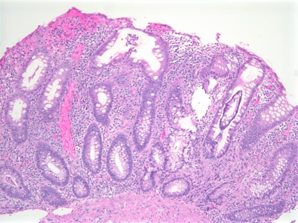 Classic Features of Untreated Ulcerative Colitis and Crohn s Disease Ulcerative colitis Diffuse continuous disease