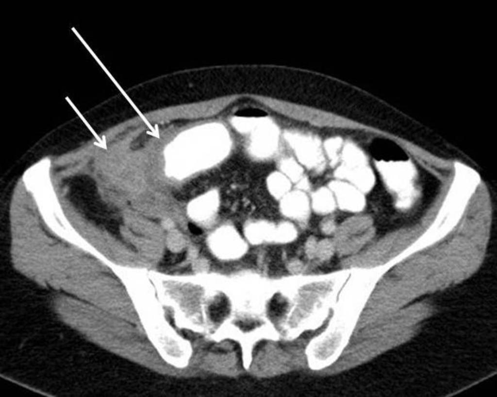 Fig. 9: CT shows corresponding right iliac fossa ill-defined soft tissue density mesenteric
