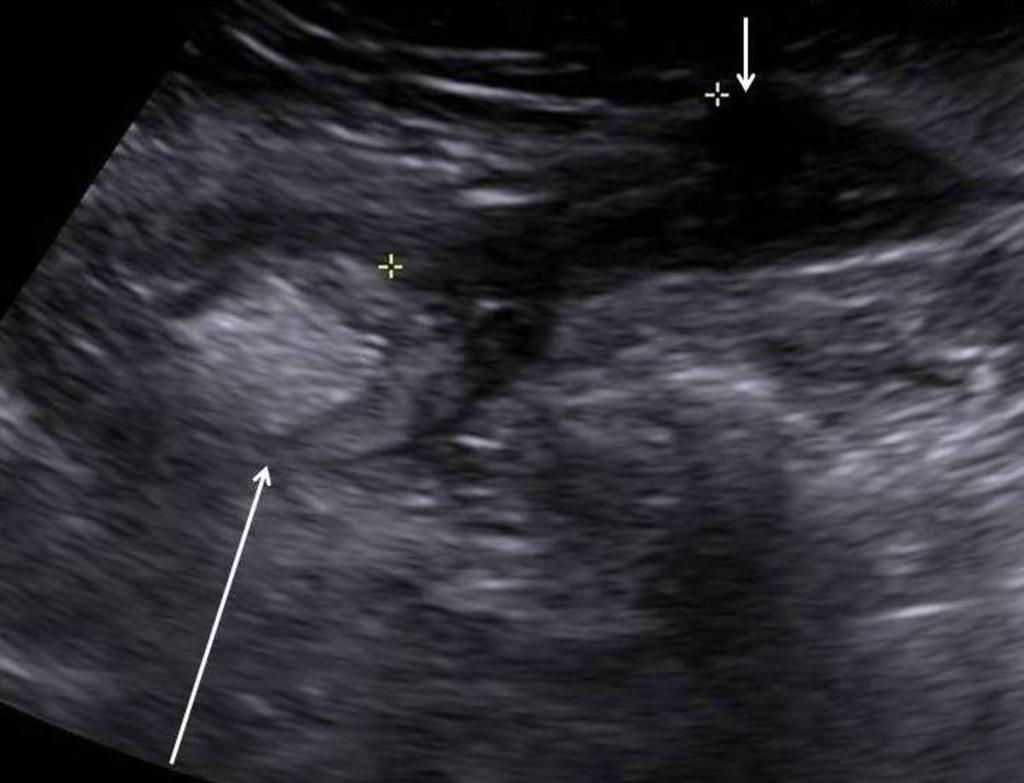 Fig. 15: Distal ileum less thickened, not hyperaemic (not shown) and 'fat wrapping' no longer seen Complications of Crohn's disease can be seen on US.