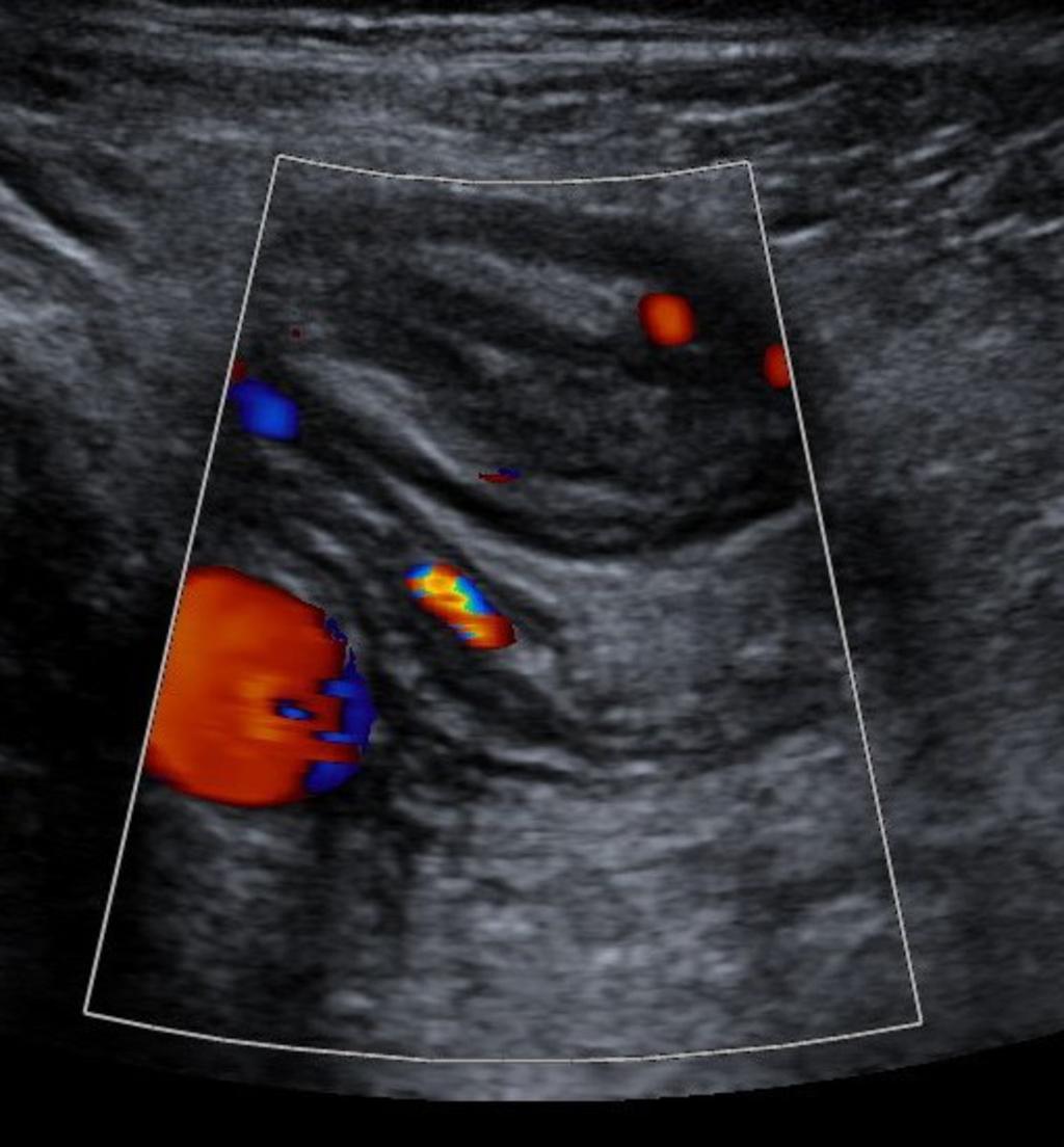 Fig. 21: Both terminal ileum and appendix are hyperaemic, with increased signal on colour Doppler In a different patient with a mildly thickened appendix (Fig