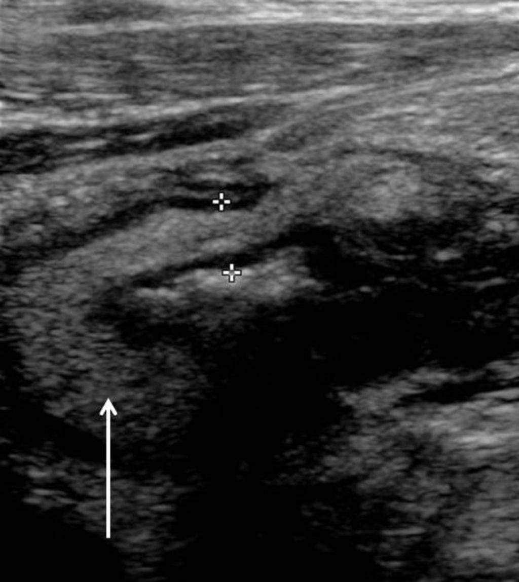 Fig. 23: Caecal wall thickening (5mm) with prominent echogenic submucosal layer (arrow), secondary to active