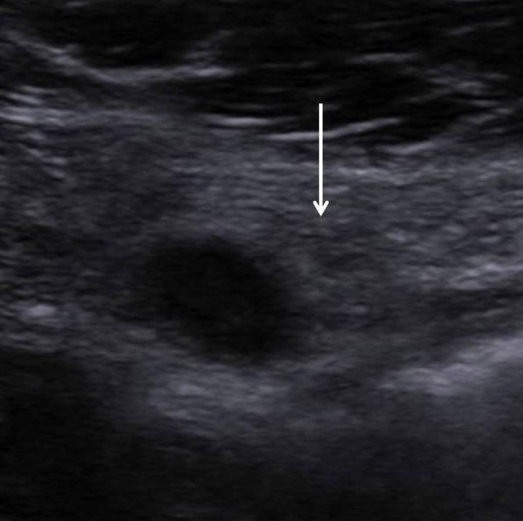 Fig. 29: Transverse image of appendix in same patient.