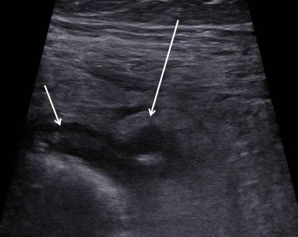 Fig. 37: Thickened colonic wall (short arrow)