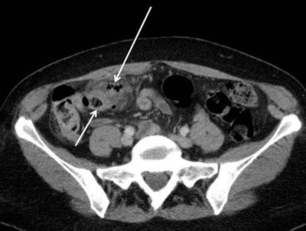 Fig. 39: CT abdomen shows inflamed diverticulum (short arrow) and free gas (long arrow) corresponding to US findings.