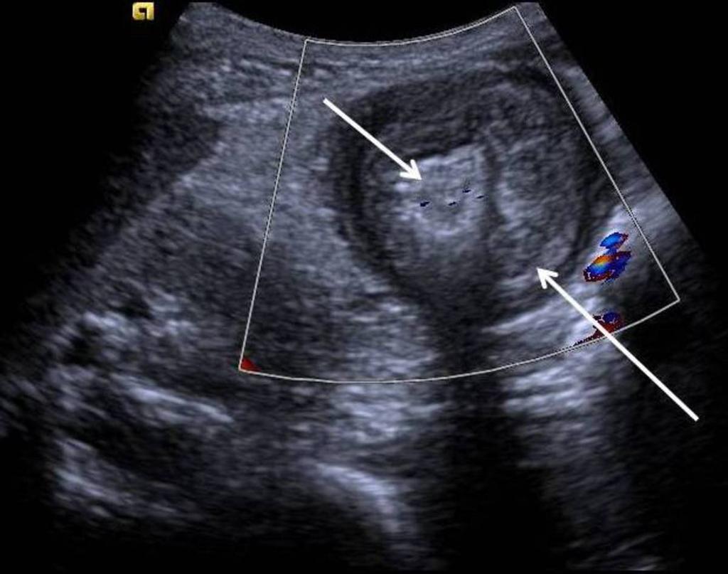Fig. 41: Gastric tumour is seen in transverse section with an echogenic central region (short arrow) surrounded by a hypoechoic rim (long arrow), so called "pseudo-kidney" sign.