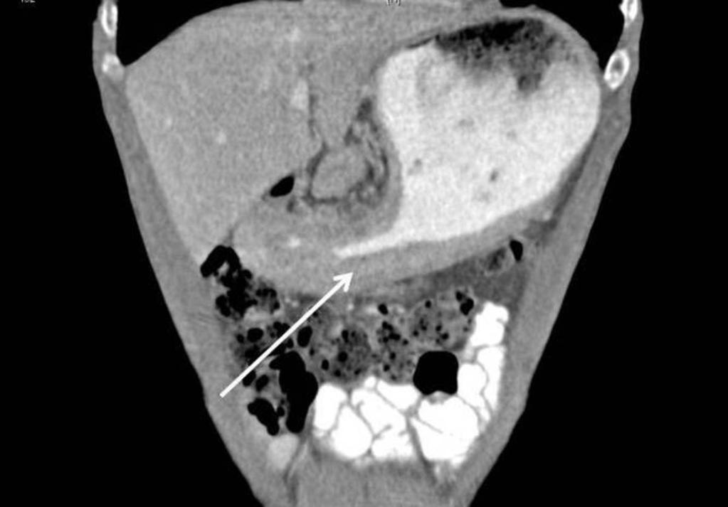 Fig. 42: Coronal reformat CT image shows diffuse gastric malignancy Reduced peristalsis can be noted in gastric tumours secondary to poor compliance.